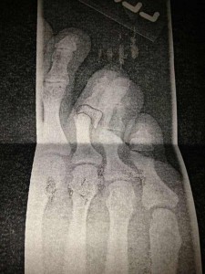 Рентгеновский снимок стопы Мэтта Беллами